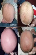 徐州三代合法助孕：如果戴着这个头盔睡觉，宝宝的头被压扁了，该怎么办？